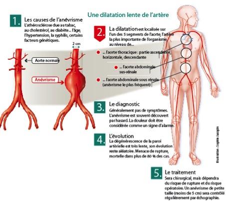 an-vrisme-de-l-aorte-abdominale-sous-r-nale-tout-savoir