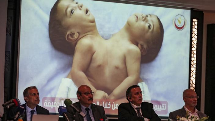 Deux Bebes Siamois Yemenites Hors De Danger Apres Leur Separation En Jordanie Technical Ripon