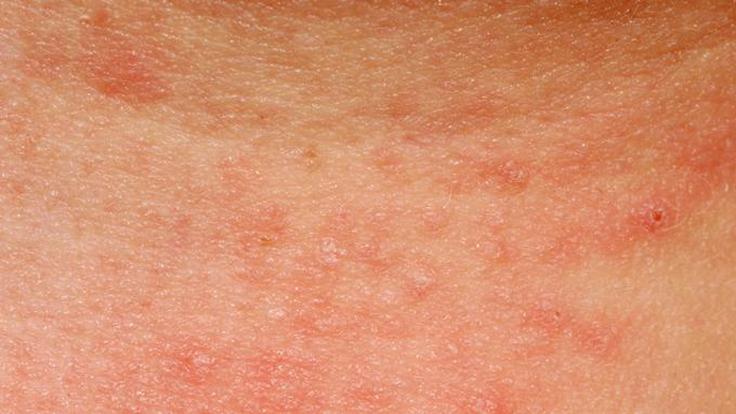 Eczma de contact : symptmes, causes et traitement