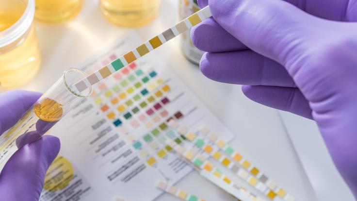 ECBU : comprendre l'analyse de ses urines et ses résultats