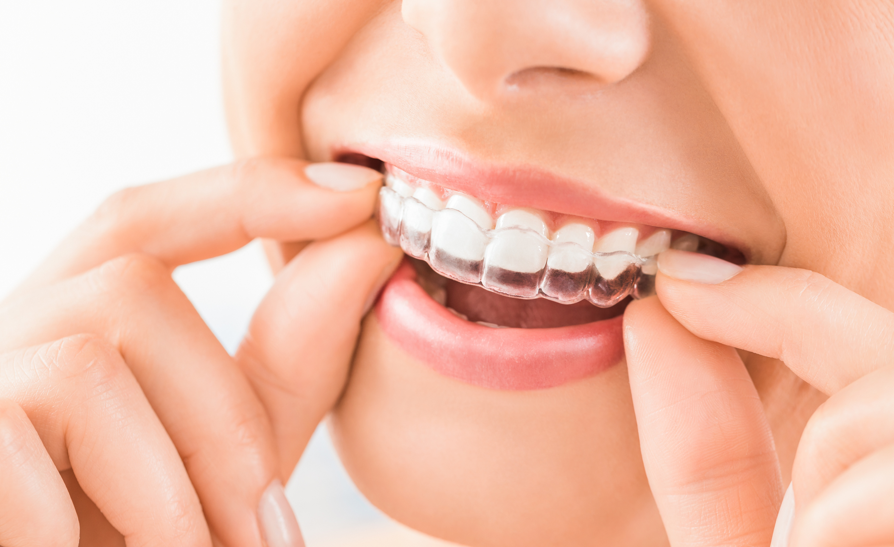 Les gouttières dentaires : bonne ou mauvaise idée ? - Magazine Avantages