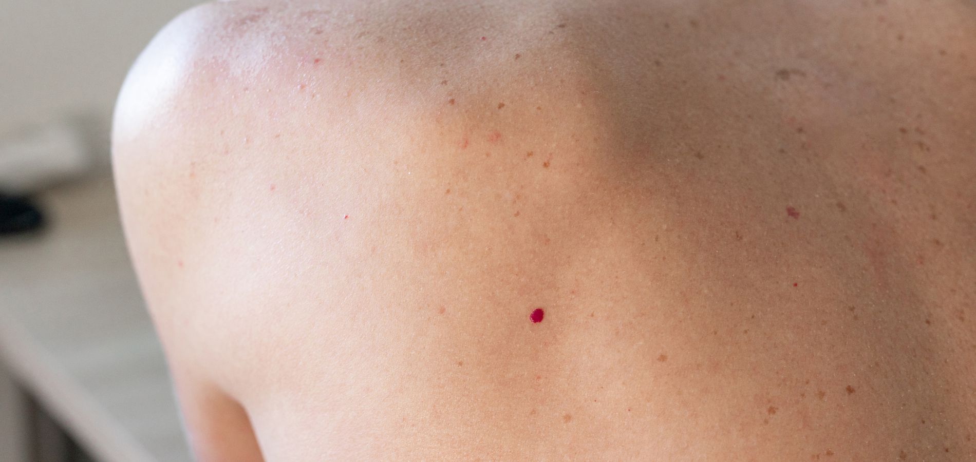 Qu'est-ce que ce petit bouton rouge qui apparaît sur la peau après 30 ans ?
