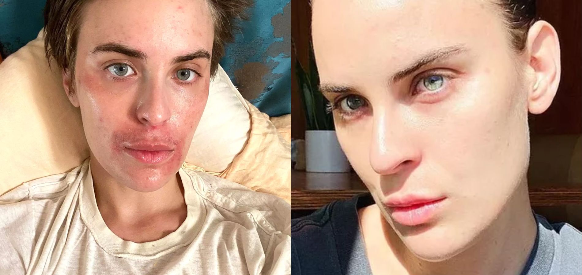 Tallulah Willis, la fille de Demi Moore et Bruce Willis, dévoile sa peau au  naturel dans un avant/après bluffant