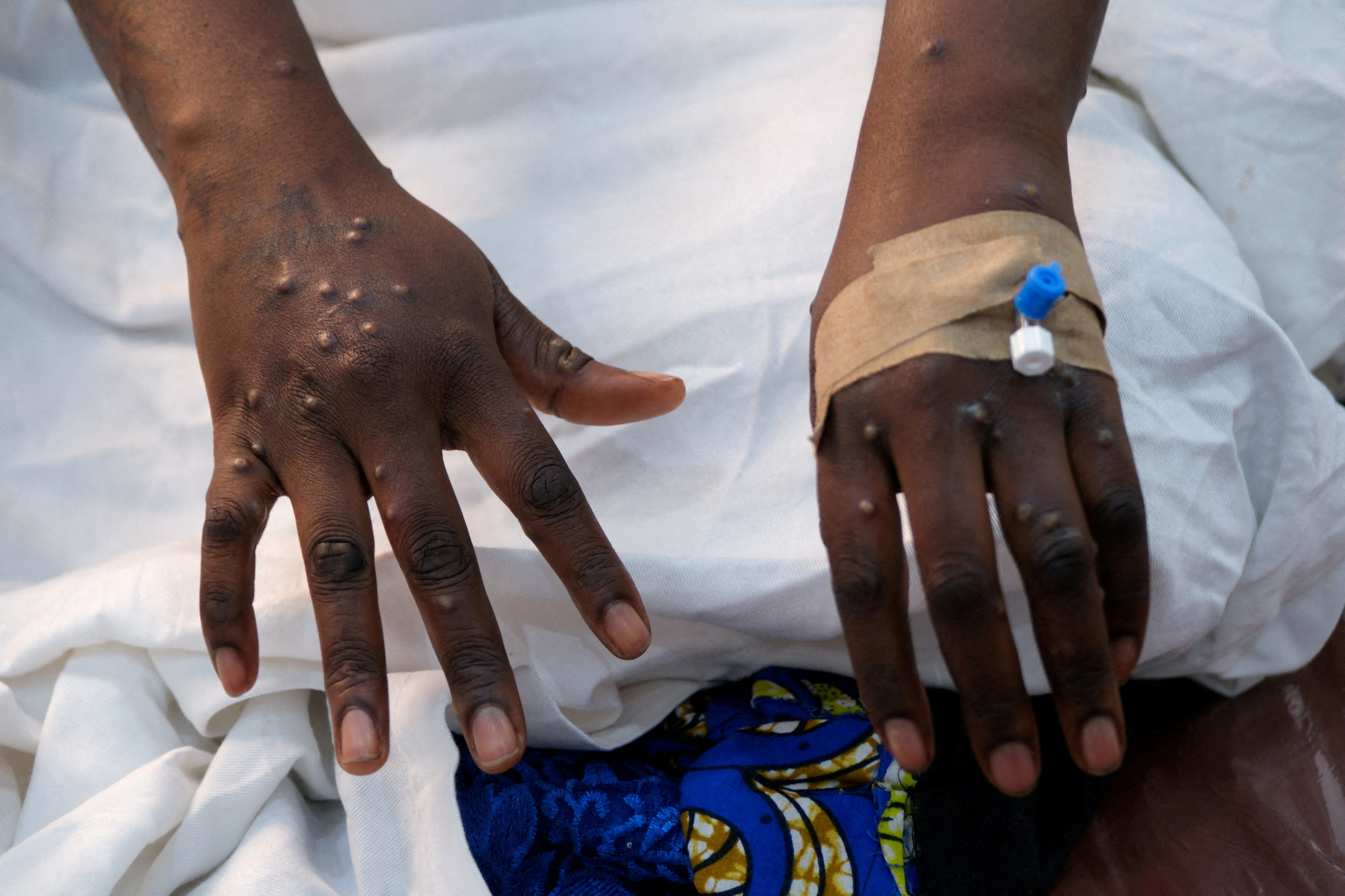 Mpox: un premier cas d'infection au nouveau variant confirmé en Allemagne