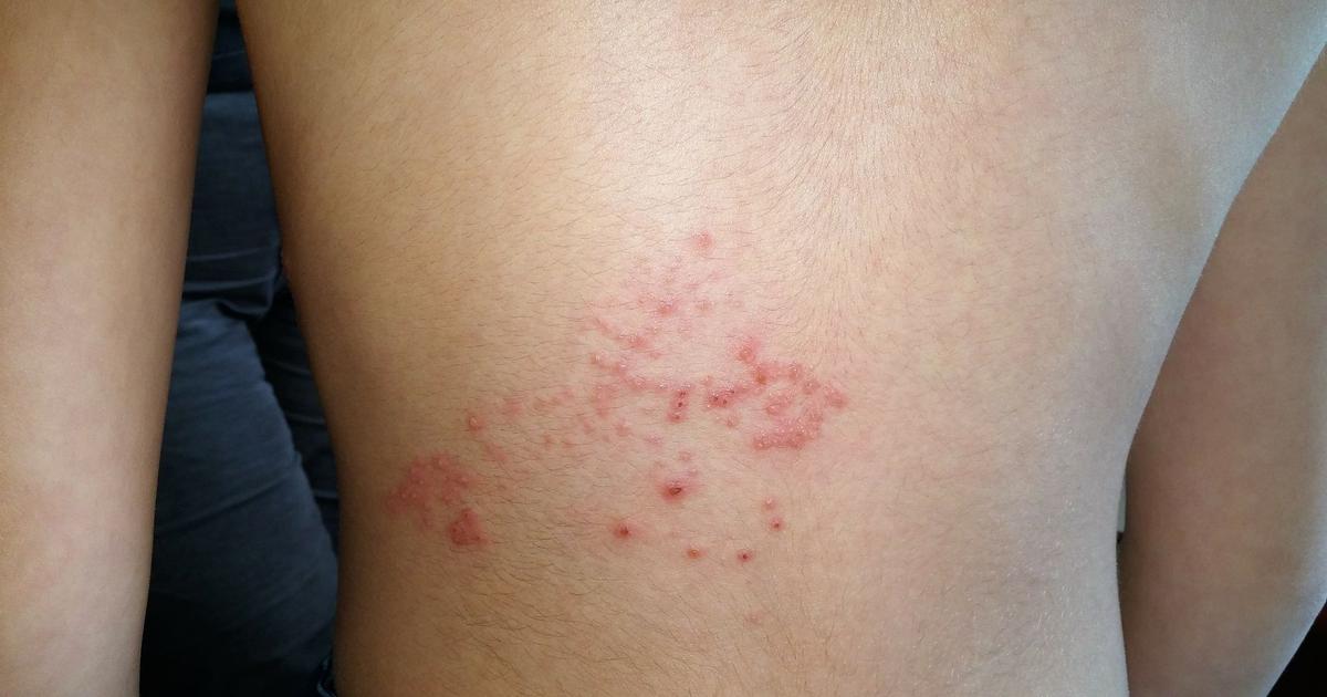 Pourquoi le zona provoque des douleurs à long terme