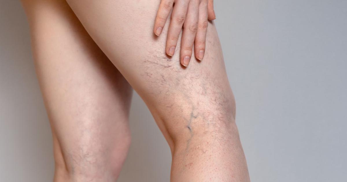 Small visible veins of the legs: what to do?