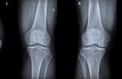 L’arthrose du genou est deux fois plus fréquente qu’il y a 100 ans