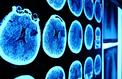 L’intelligence artificielle pourrait améliorer la prise en charge des tumeurs au cerveau