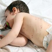 Attention, les cas de varicelle se multiplient