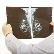 Cancer du sein : informer avant de dépister