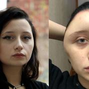 Coloration pour cheveux: une jeune femme met en garde contre le risque d’allergie