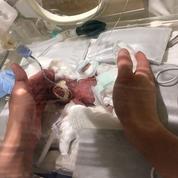 Japon: un prématuré pesant 268 grammes à la naissance a survécu