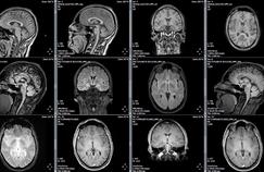 Des métamatériaux pour des IRM du cerveau plus précises