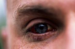 Les blessures à l’œil sont souvent plus graves qu’on ne le pense