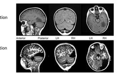 Épilepsie : un enfant guérit après l’ablation d’une partie de son cerveau