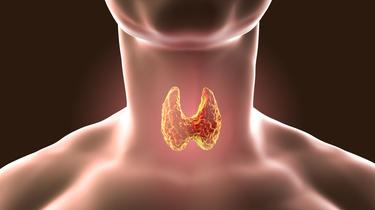 Hypothyroïdie: certaines personnes pourraient être diagnostiquées à tort