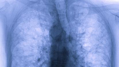 Chantal Raherison-Semjen insiste sur les risques de fibrose, une présence excessive de tissu conjonctif fibreux dans les poumons, que peut engendrer une affection au Covid.