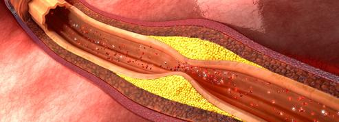 Athérosclérose: comment savoir si nos artères sont en mauvaise santé?