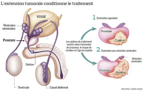 récidive cancer prostate)