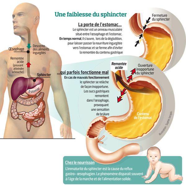 Des stratgies efficaces contre le reflux gastrique