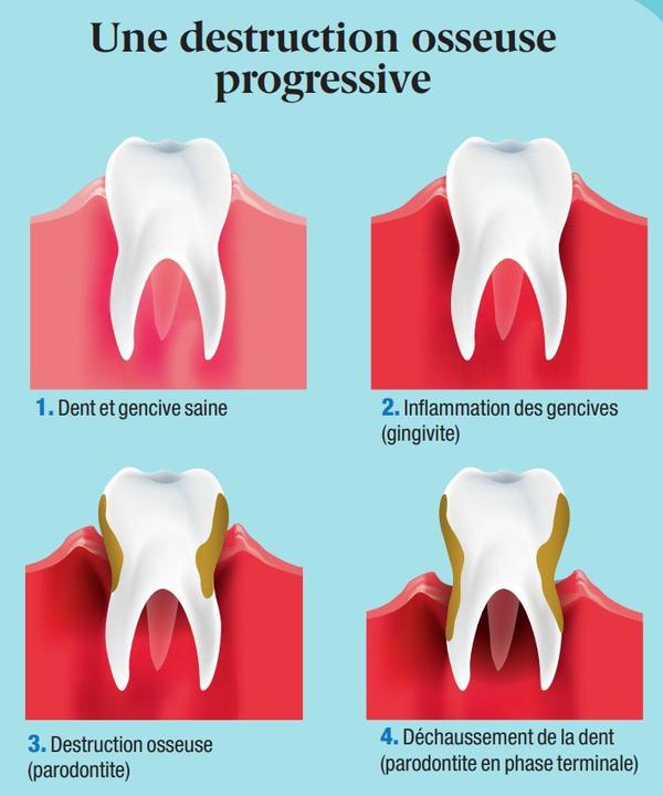 La moitié de la population est touchée par une maladie parodontale, dont 10 % de façon sévère. Cette pathologie d’origine infectieuse, qui touche et détruit les tissus de soutien des dents (gencives et os), évolue sur plusieurs dizaines d’années.