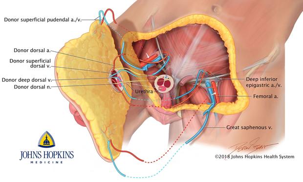 Les chirurgiens américains ont greffé toute la partie basse de l’abdomen. Ils ont ensuite connecté l’urètre, les nerfs, les veines et les artères.
