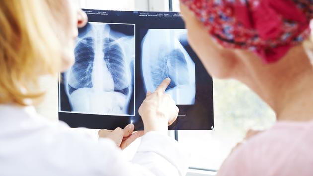 Cancer Poumon Combien De Temps A Vivre Un traitement prometteur contre des cancers avancés du poumon