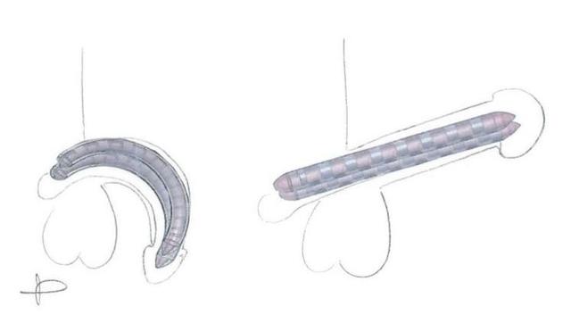Schéma de la prothèse de pénis à mémoire de forme. Au repos (à gauche) , et en érection (à droite) (Le Figaro).