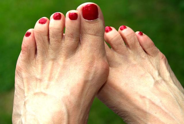 Lutter Contre L Hallux Valgus