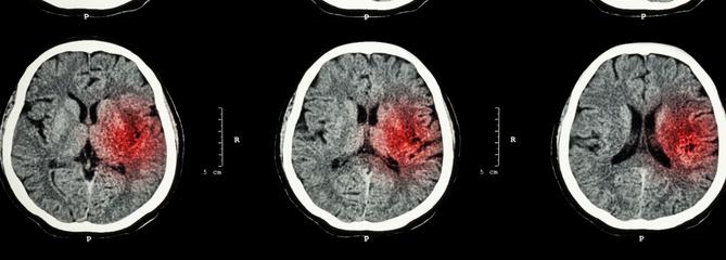 Six choses à savoir sur les accidents vasculaires cérébraux