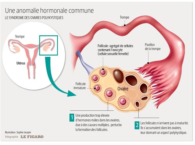 Syndrome des ovaires polykystiques: quand les ovaires se masculinisent