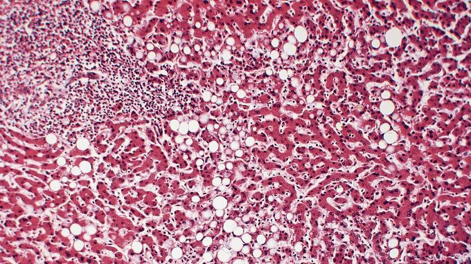 Vue au microscope optique d’un foie atteint de stéatose. Les cercles blancs sont de la graisse accumulée dans les cellules du foie.