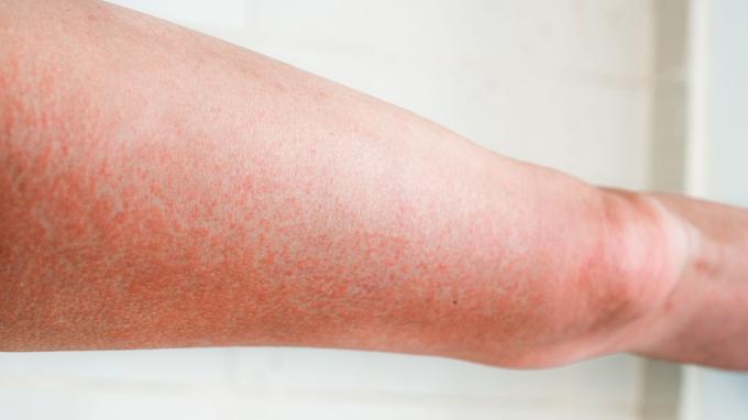 Une lucite estivale se caractérise par des petits boutons rouges sur la peau exposée au soleil.