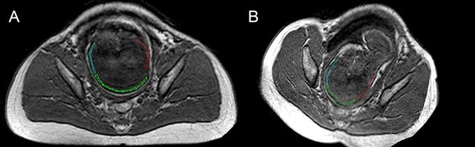 (A) IRM du bassin réalisée avant l’accouchement ; (B) IRM réalisée pendant la seconde phase du travail. On y voit les fontanelles (en bleu, vert et rouge) se chevaucher légèrement.