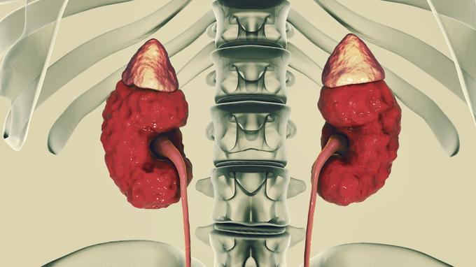 comment enlever des kystes sur les reins