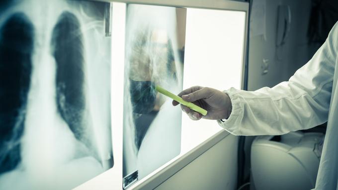 Cancer Poumon Combien De Temps A Vivre Une femme meurt d’un cancer après avoir reçu les poumons d’une fumeuse