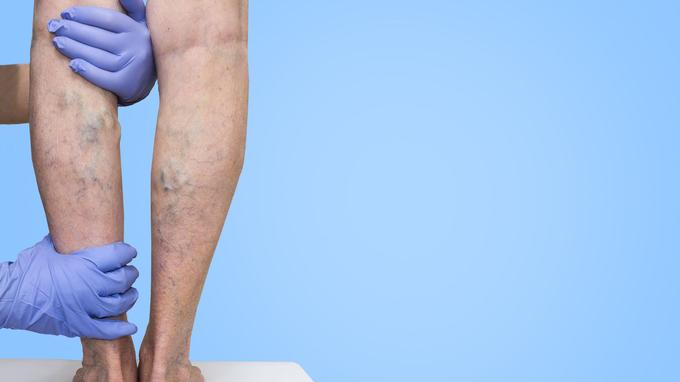 Embolie pulmonaire: la phlébite est un signe d’alerte sérieux