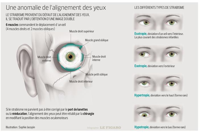 Strabisme Il Est Imperatif D Intervenir Avant L Age De 3 Ans