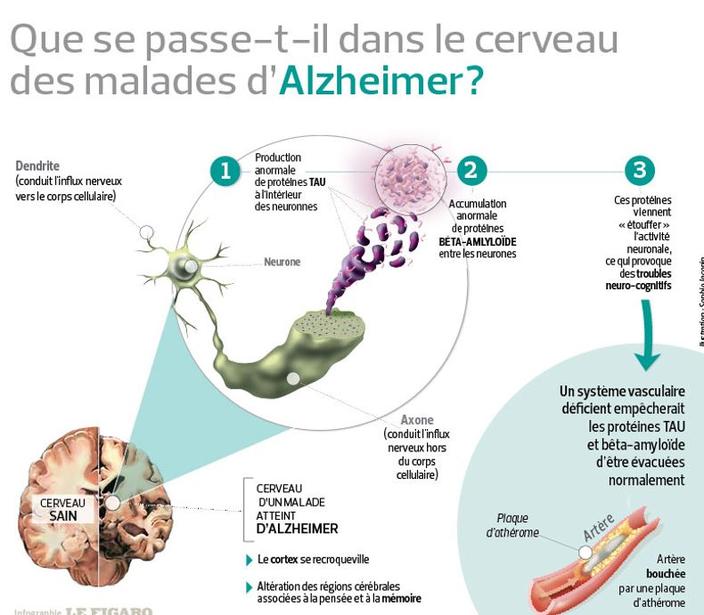 Que se passe-t-il dans le cerveau des malades d’Alzheimer