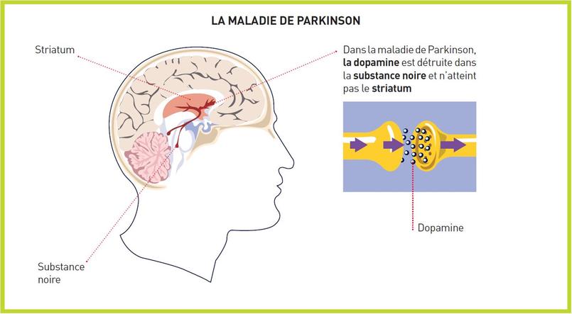 Journée Mondiale contre la maladie de Parkinson : où en est la recherche