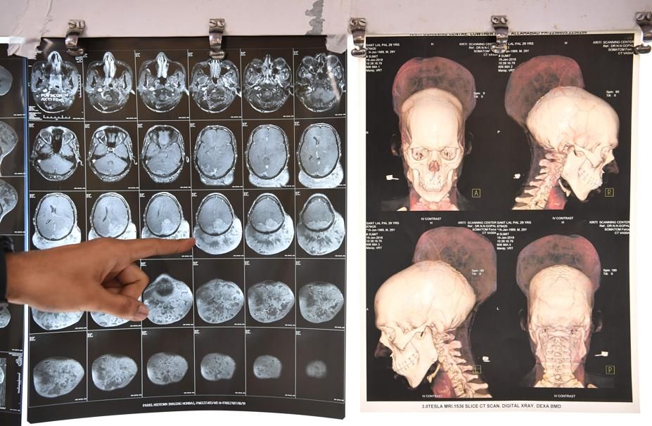 Un homme atteint d'une tumeur au cerveau de 1,8 kg a été opéré en Inde
