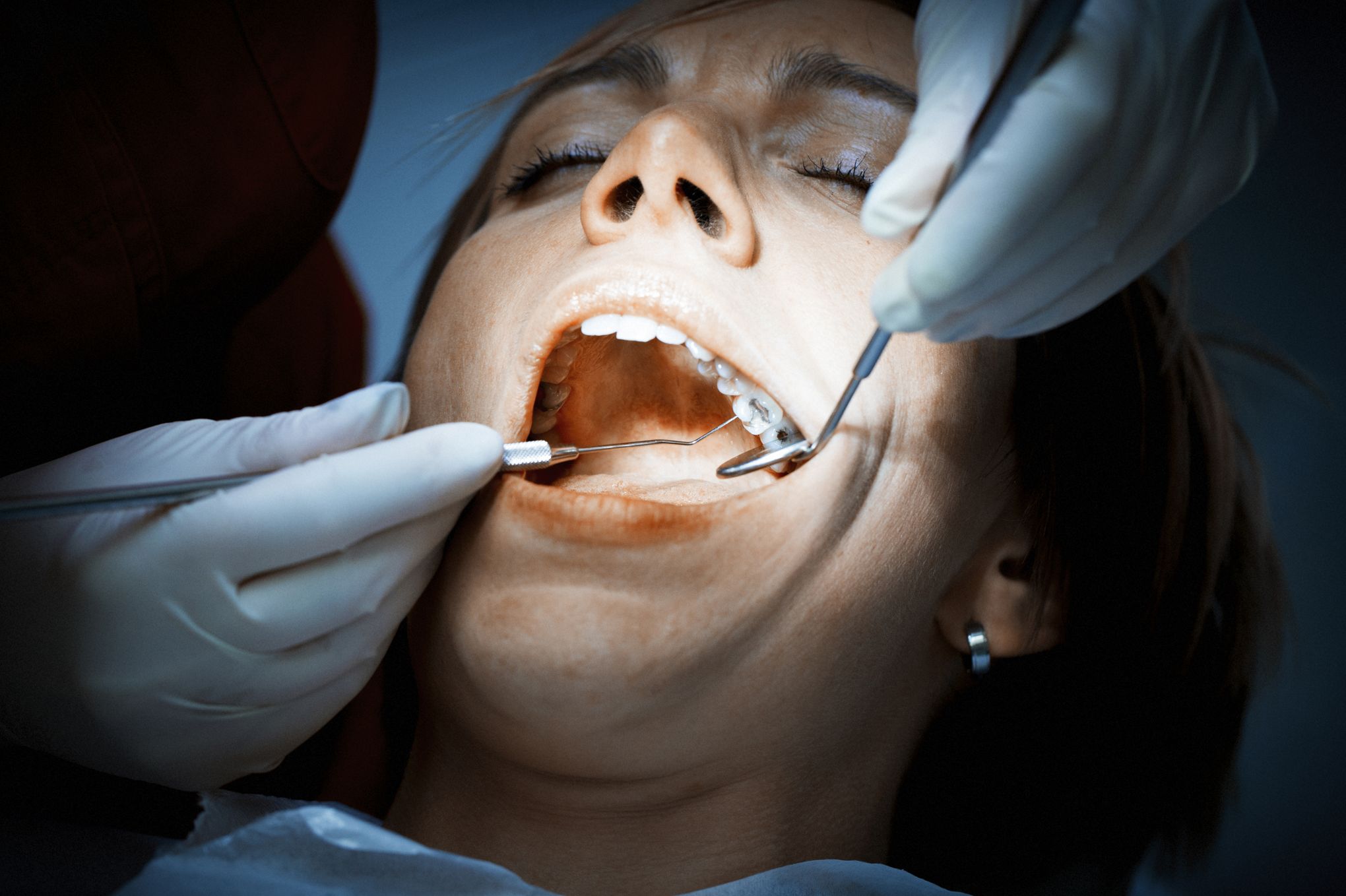 Le mercure du plombage dentaire : dangereux ou pas ?