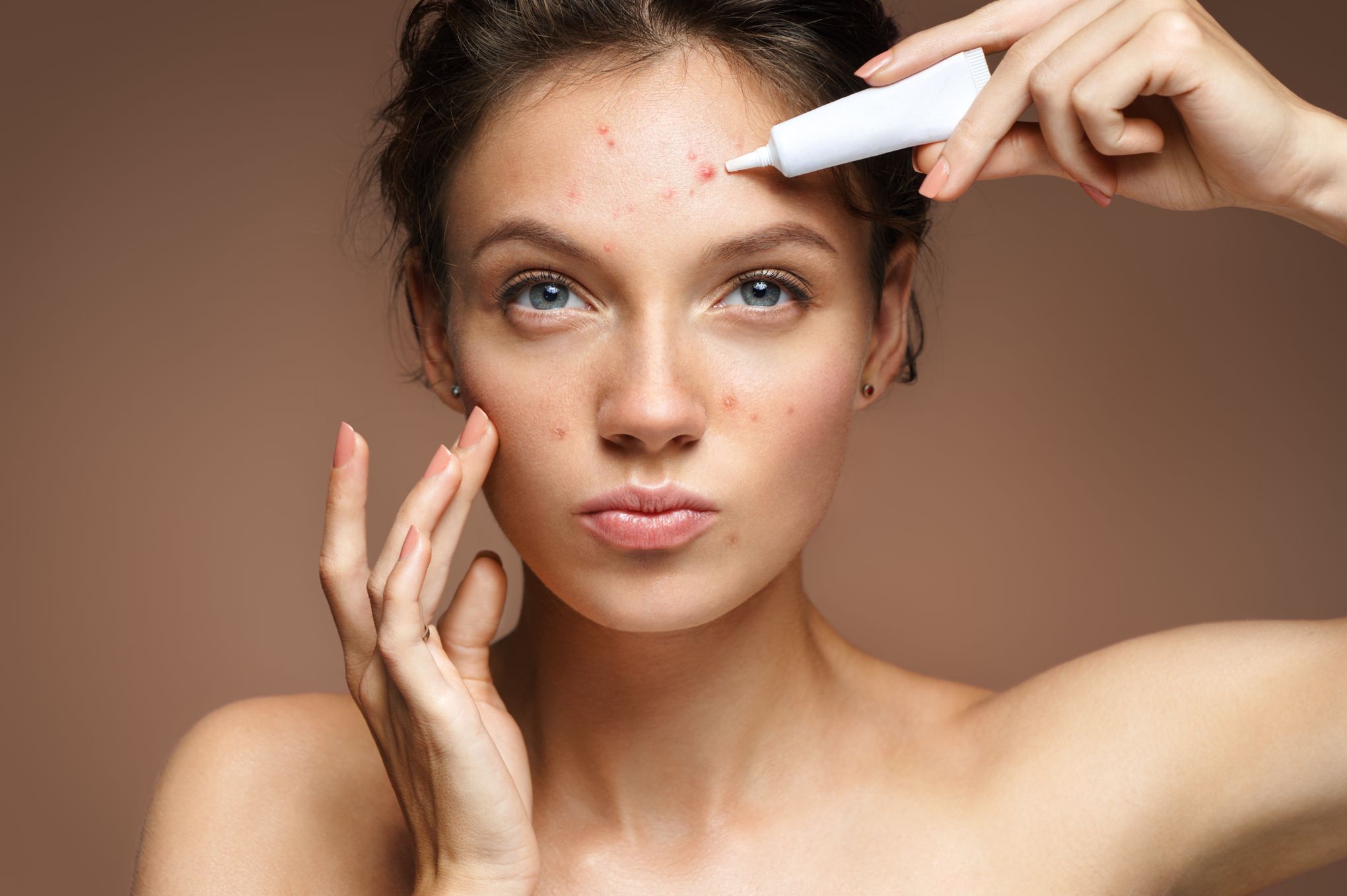 Acne Comment S En Debarrasser Efficacement