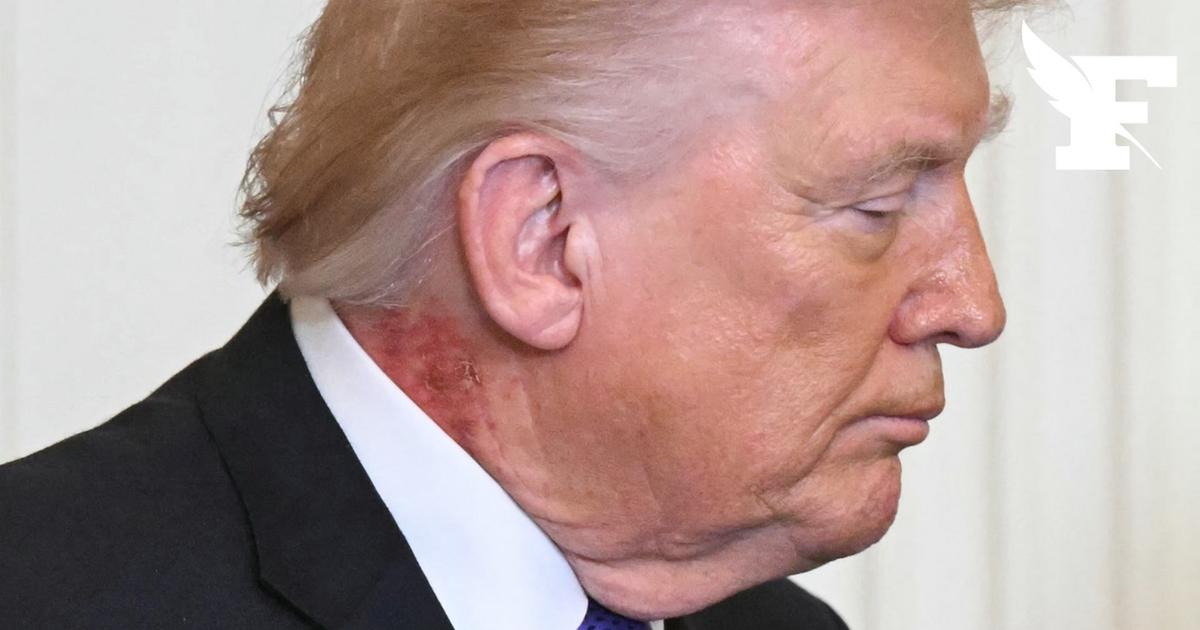Donald Trump aperçu avec une grande plaque rougeâtre dans le cou lors d’une cérémonie à la Maison-Blanche