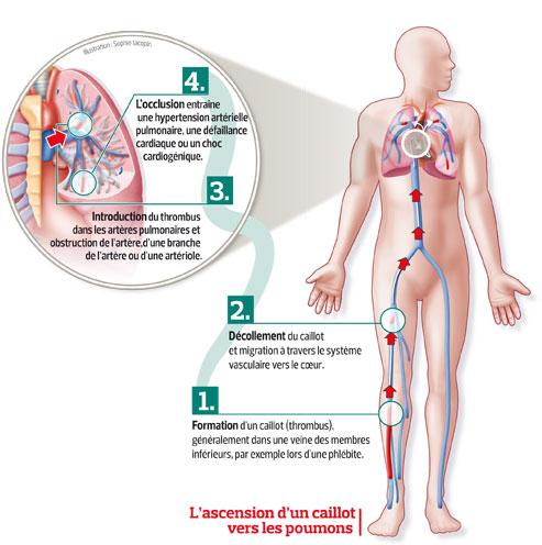 L'embolie pulmonaire mieux diagnostiquée