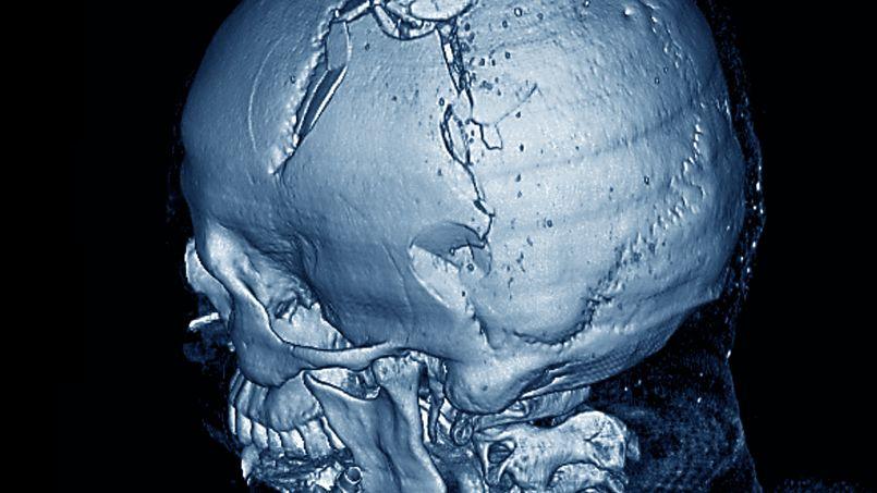 Traumatisme crânien : des degrés de gravité variables
