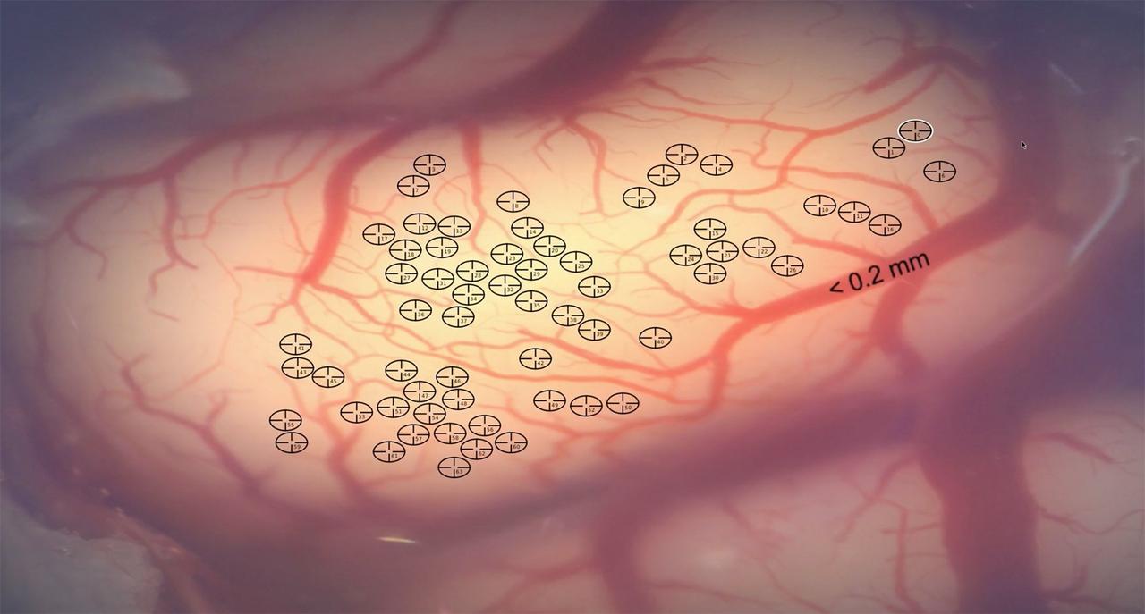 La position de chaque fil est attribuée très précisément, au plus près des neurones, en évitant d’endommager le dense système vasculaire à la surface du cerveau.