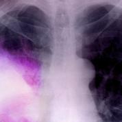 Un lien établi entre pneumonie et risques cardiovasculaires