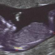 Trisomie 21 : vers la fin des amniocentèses ?