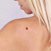 Cancer de la peau : surveillez vos bras